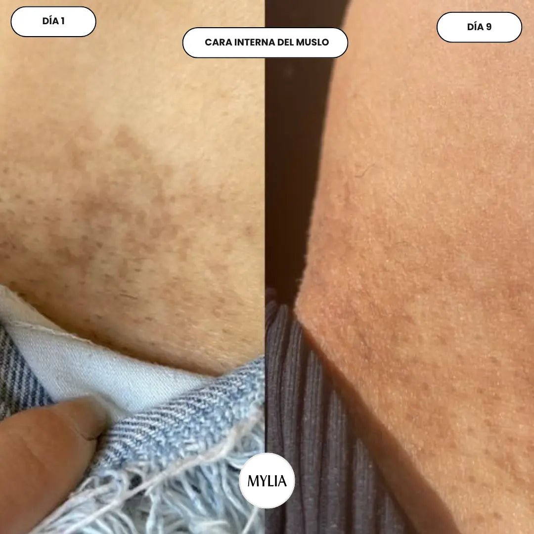 It evens out skin tone and visibly reduces persistent dark spot. - Mylia Care